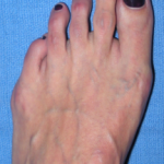 Bunion Surgeon in Midtown NYC