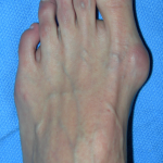 Bunion Corrector Surgery in Midtown NYC