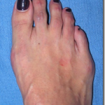 Gramercy Bunion Treatment