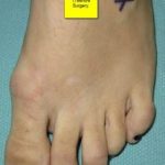 foot doctor for hammertoe Chelsea