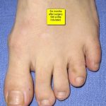 hammertoe surgery in Chelsea