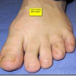 hammertoe condition in Union Square