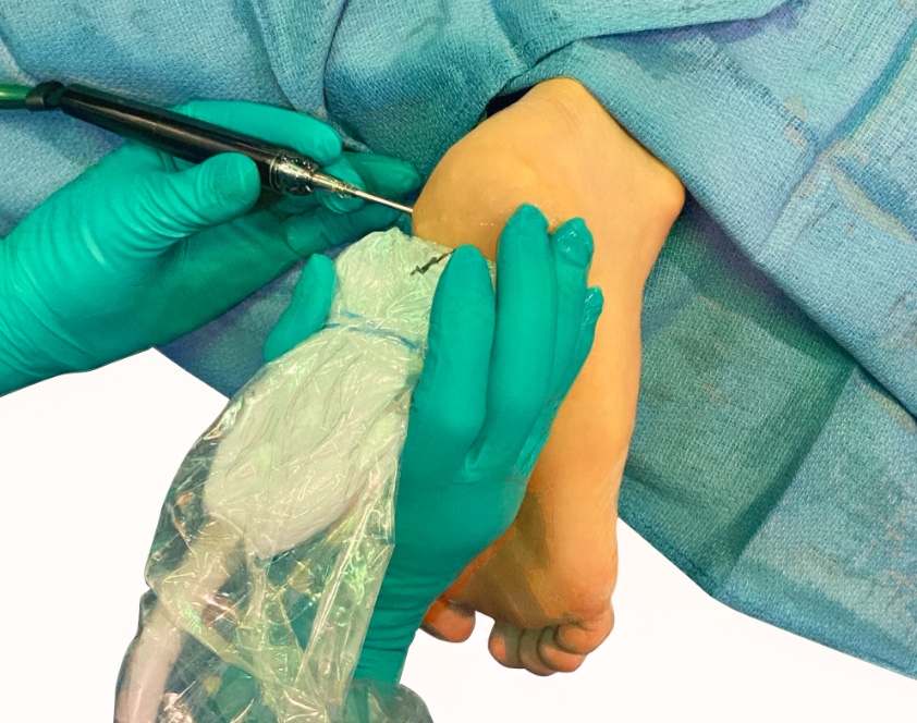 Tenex Treatment for Plantar Fasciitis | City Footcare