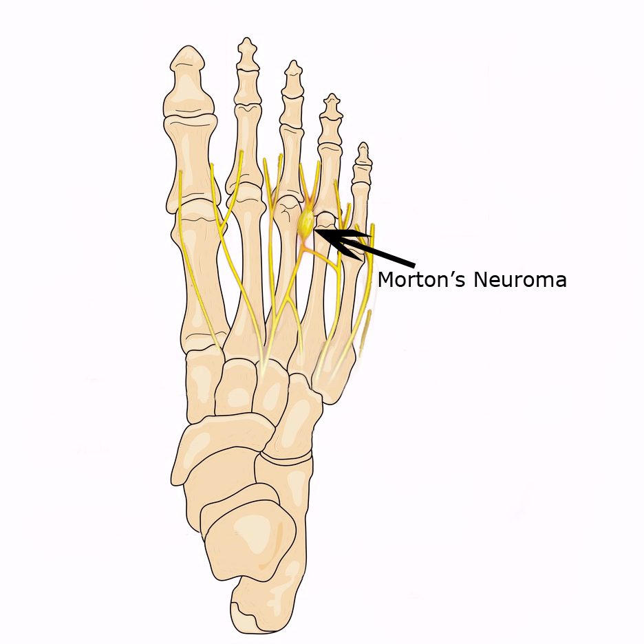 Foot bones with neuroma v01