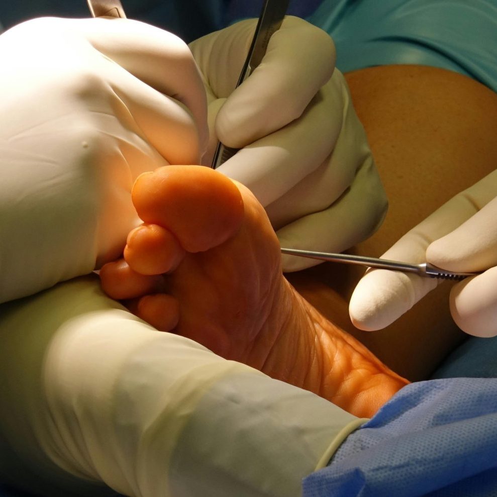 hammertoe treatment Hell's Kitchen NYC hammertoe treatment Hell's Kitchen NYC